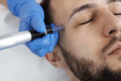 needling skin